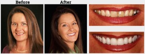 A smiling woman before and after cosmetic treatment
