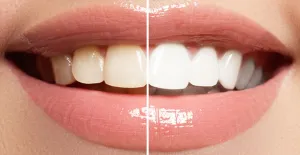 White teeth compared to stained teeth