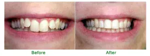 Before and after braces
