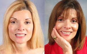 A smiling woman before and after cosmetic treatment