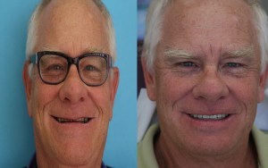 A smiling man before and after cosmetic treatment