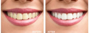 Before and after teeth whitening