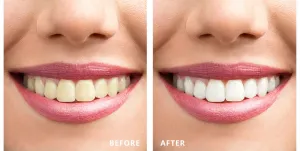 Yellow teeth to bright white teeth after whitening